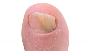 grzybica paznokci